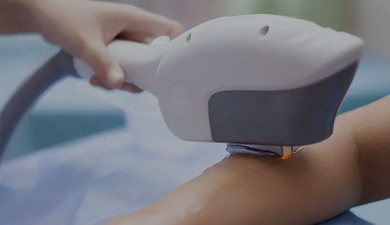 Depilazione laser a diodi