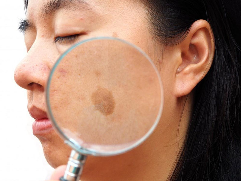 Picosecondo laser: un buon aiuto per rimuovere Melasma