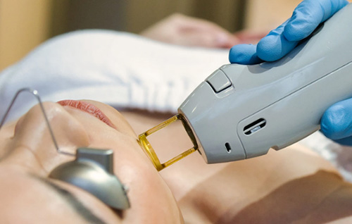 Perché sempre più clienti scelgono il laser Alexandrite per fare la depilazione?